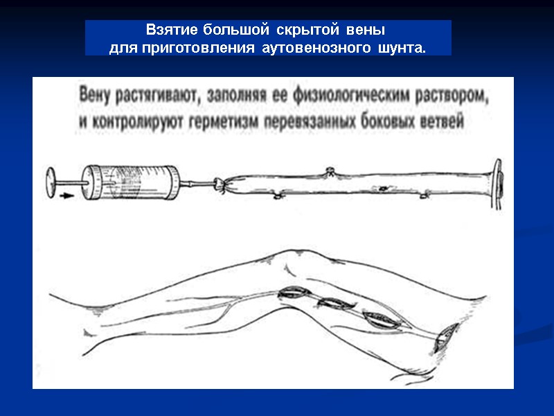 Взятие большой скрытой вены  для приготовления аутовенозного шунта.